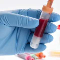 Ręka w niebieskiej rękawiczce trzyma probówkę z krwią. W tle pojemnik z żółtym płynem i inne próbki. To może oznaczać krew w moczu.